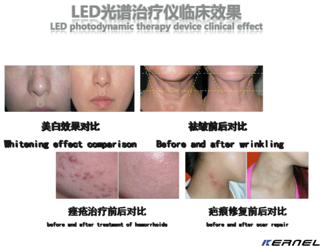 Powerful Photodynamic Therapy LED Light For