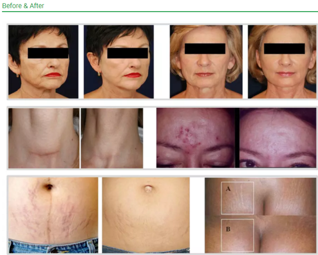 Powerful Photodynamic Therapy LED Light For