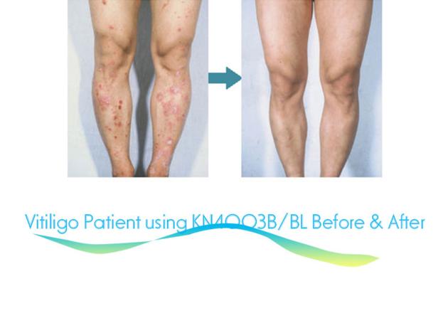 UVB LAMPS FOR VITILIGO Cabinet Narrow