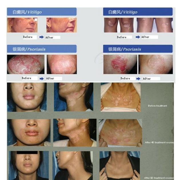 Vitiligo UVB Combs UVB Phototherapy Lamp