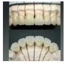 metal porcelain teeth