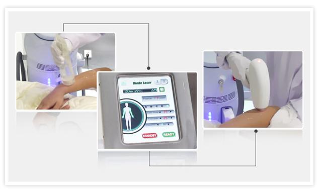 Best Effect Diode Laser Hair Removal