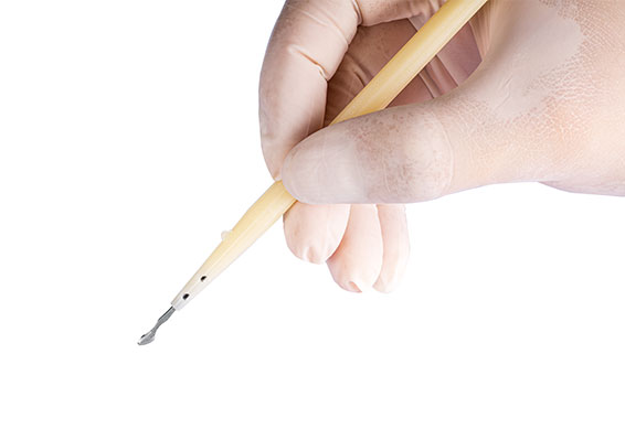 Lymphovenous Stripping Knife