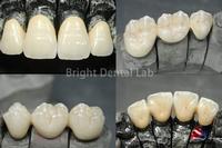 dental PFM crowns