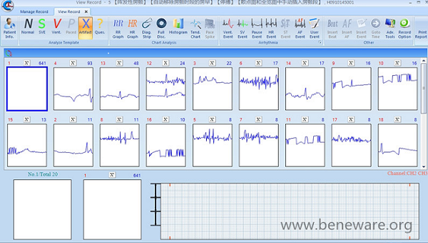 Beneware CardioTrak Holter Analysis Software World First AF Automatic Analysis