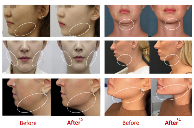 LIPO VELA V Premium Lipolysis Solution