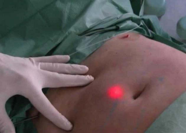 15watts 1210nm Best Laser Fat Removal