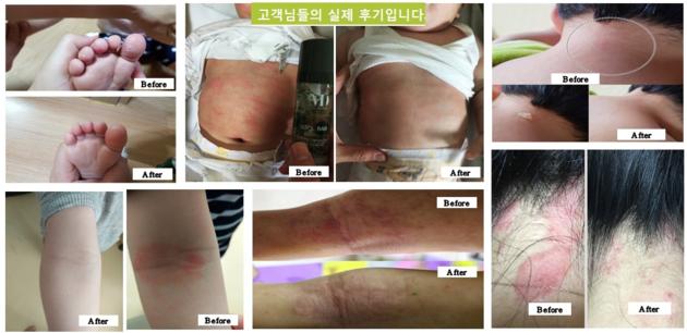 ATO BAB Atopy Atopic Dermatitis Eczema