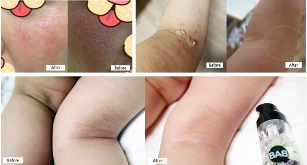 ATO BAB Atopy Atopic Dermatitis Eczema