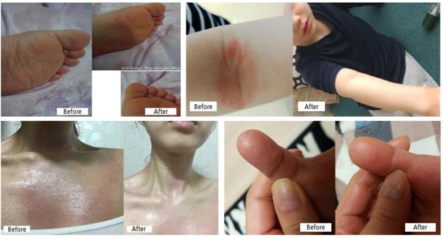 ATO BAB Atopy Atopic Dermatitis Eczema