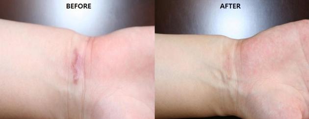 Redergen Body Bleaching Whitening Cream No