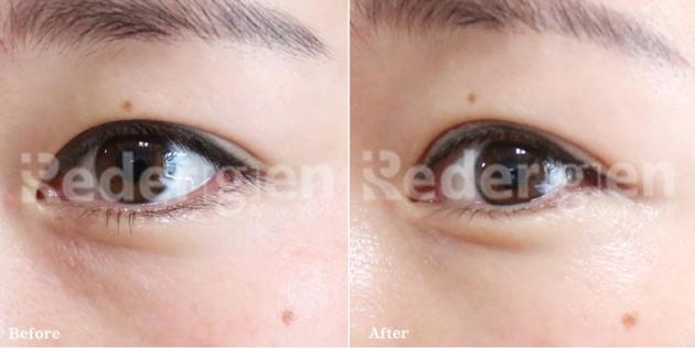 Redergen Eye Bag Remedy Under Eyes