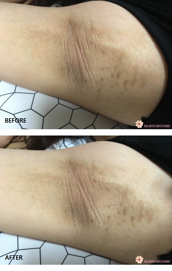 Redergen Underarm Armpit Brightening Bleaching Whitening