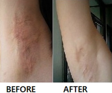 Redergen Underarm Armpit Brightening Bleaching Whitening