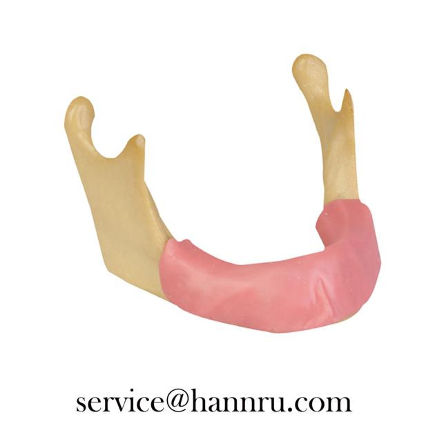 HannRu-Dental Model, Implant Insertion Mandible Model Practice Model, Implant Model, Drilling Model