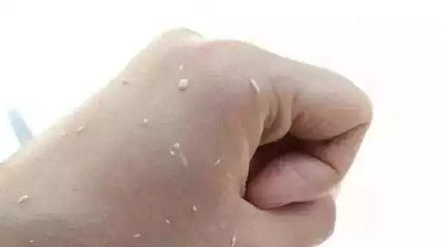 Is the skin horny skin rubbed by Rubibo? No, that is the love crystallization of Carbomer and Cousin
