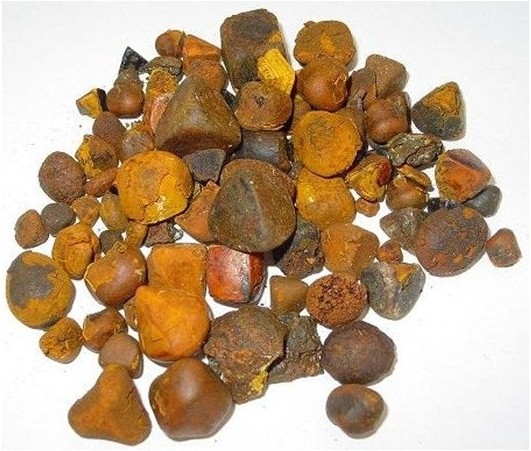 GALLSTONES