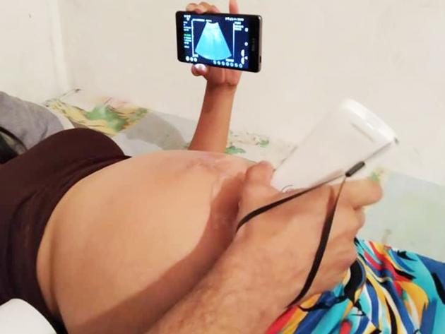 Wireless Ultrasound Probe Used in OB&GYN