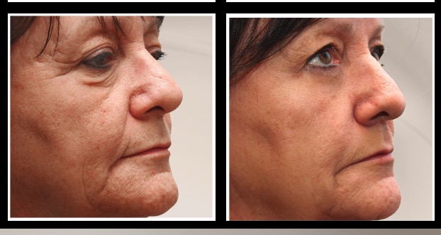Instant facelift serum