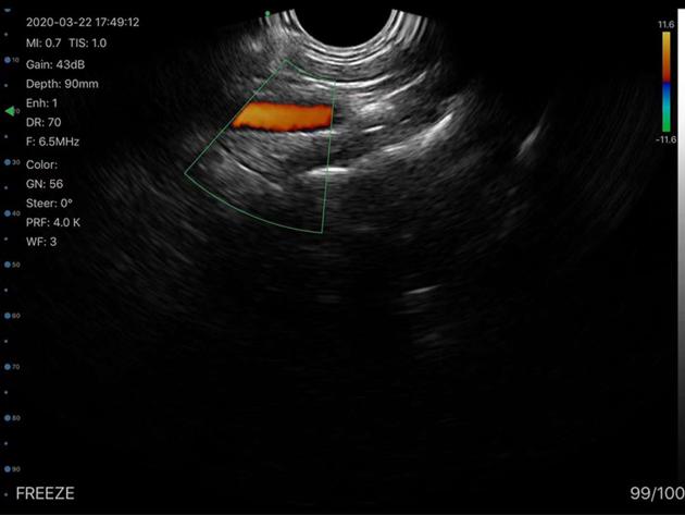 5CT 2in1 Palm Doppler Ultrasound