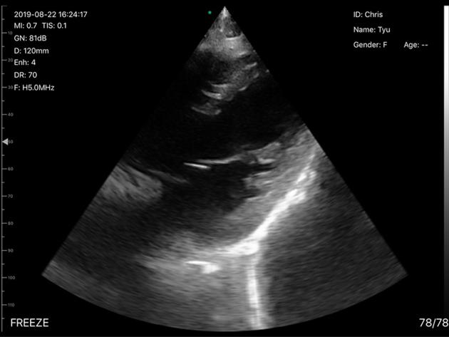 5CPL 3in1 Palm Doppler Ultrasound