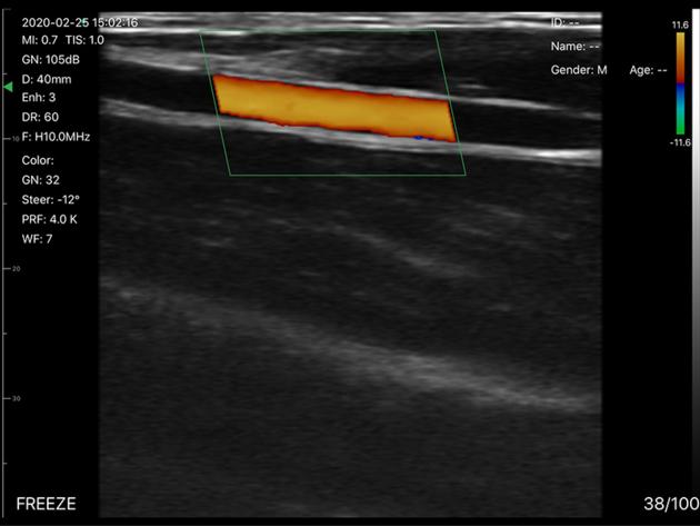 5CPL 3in1 Palm Doppler Ultrasound