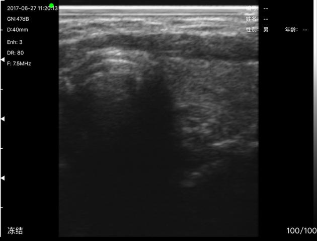 3L Linear Palm B W Ultrasound