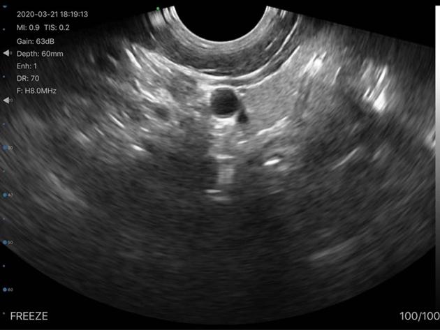 5CT 2in1 Palm Doppler Ultrasound