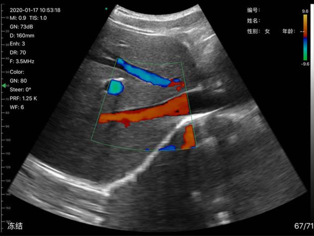 6CPL 3in1 Palm Doppler Ultrasound