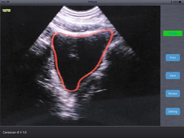 4D Wireless Bladder Scanner
