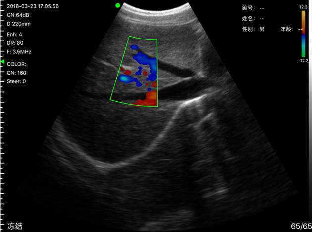 5CT 2in1 Palm Doppler Ultrasound