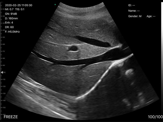 5CL 2in1 Palm Doppler Ultrasound