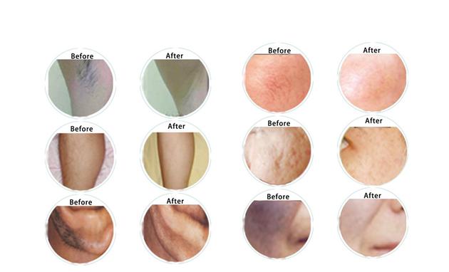 FDA Amp CE Approved IPL Machine