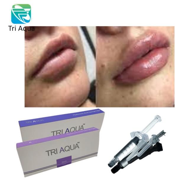 Dermal Filler Hyaluronic Acid