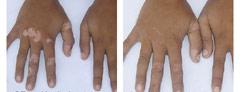 Sell Herbal remedy for Re-pigmentation Of Vitiligo / Lecuderma