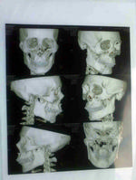 Medical one-side dry film(CT-8) 