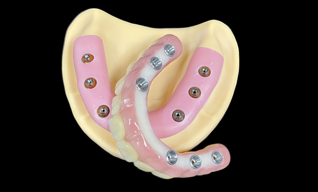 All Zirconia Screw Retained Bridges Myy