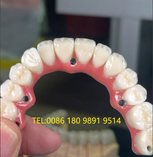 Implant Cement Bridge China Dental Lab