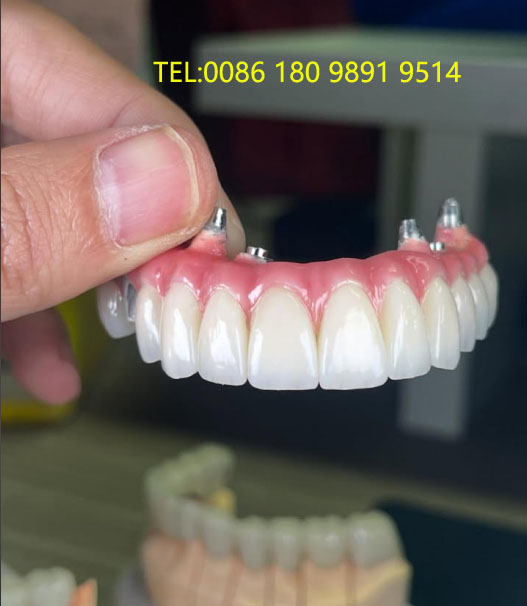 China dental screwed denture manufacturers, suppliers, factory