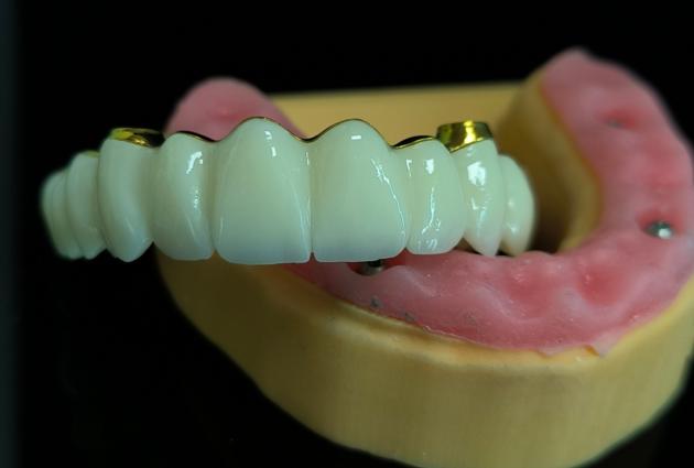 Implant Cement Bridge China Dental Lab