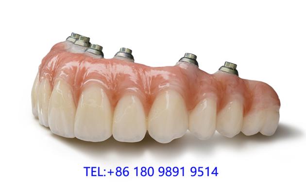 All Zirconia Screw Retained Bridges Myy