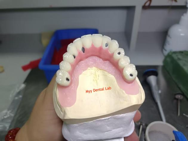 Implant Screwed Bridge China Dental Lab
