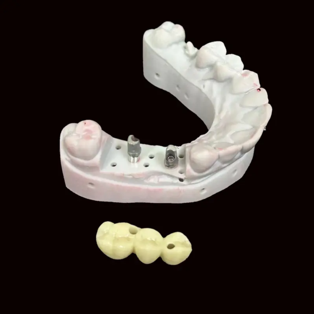 Implant Cement Bridge - China Dental Lab Cement Implant Bridge, Good Quality, Good Fitting