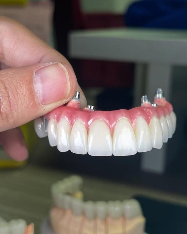 All-Zirconia Screw-Retained Bridges-Myy Dentallab