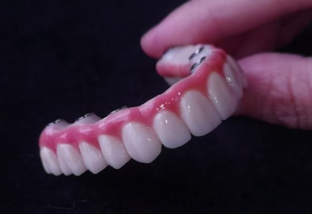 Implant Screwed Bridge - China Dental Lab Implant Crown 