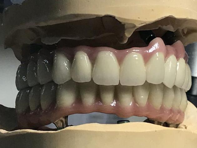 Dental Porcelain Veneer From China Dental Lab