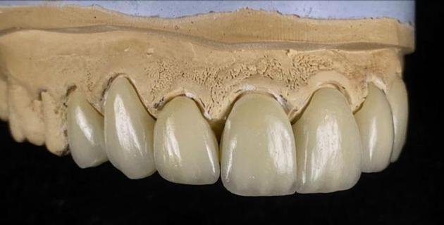 China Dental Lab Dental Lab Outsourcing