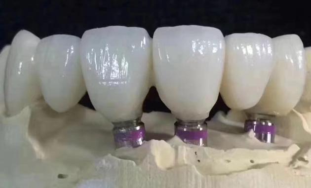 Dental Lab China, Dental Laboratory China, China Outsourcing Dental Lab, Dental Lab Chinese