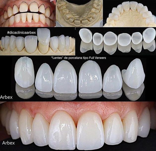 Dental Porcelain Veneer From China Dental