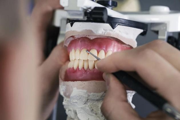 Dental Porcelain Veneer From China Dental